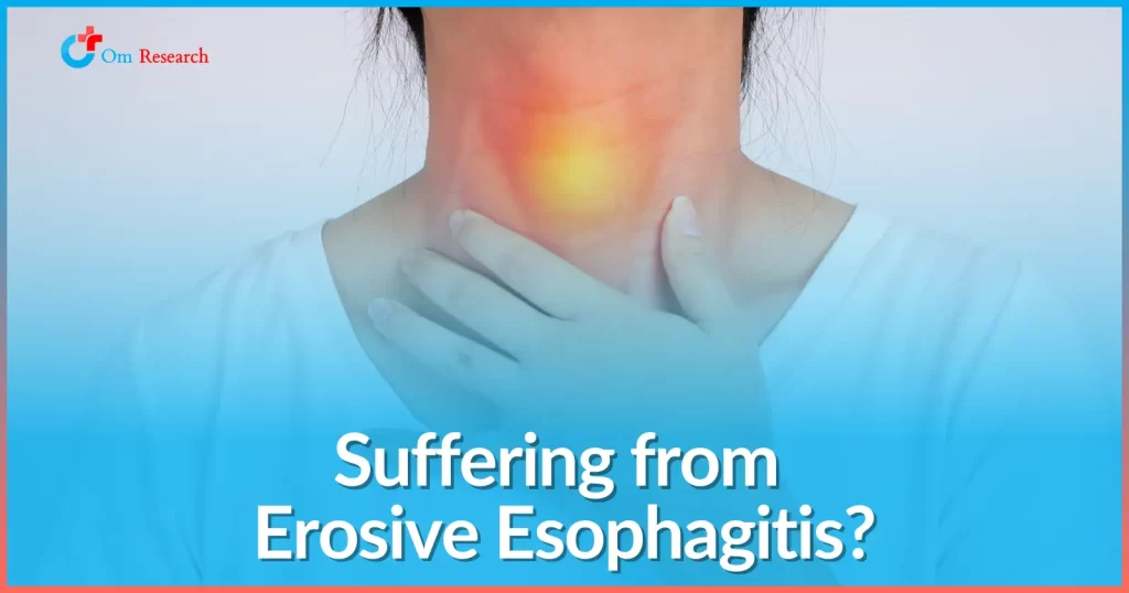 Erosive Esophagitis: Symptoms, Treatments, and Esophagus Health