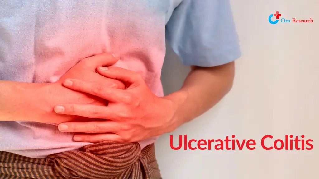 Ulcerative Colitis From Symptoms And Causes To Treatment And Research Options 2024 Guide Om 5489